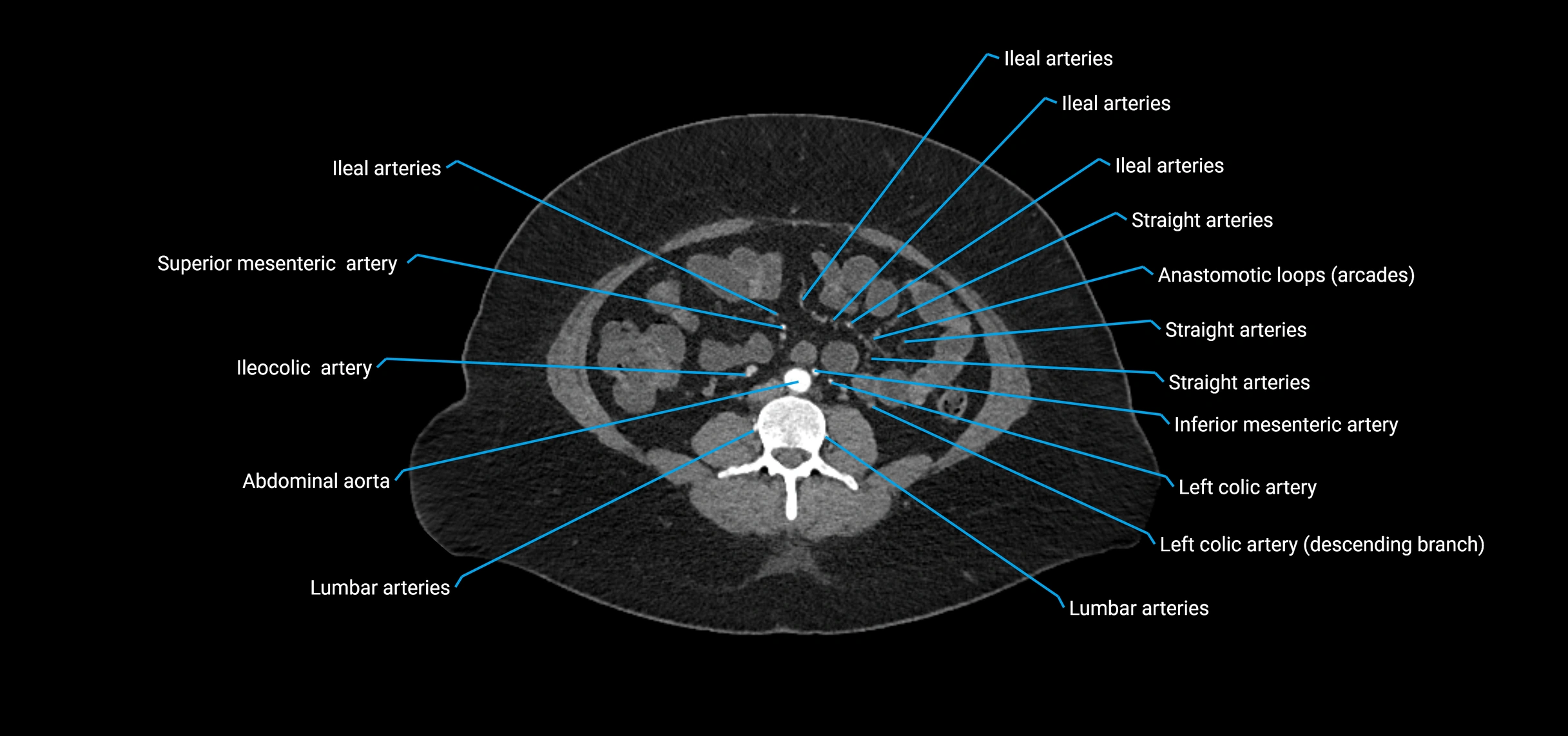 CTA abdomen axial cross sectional anatomy labelled image_119 (2).webp